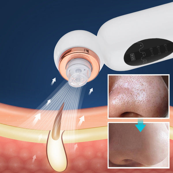 SkinNova Hydrodermabrasion Gesichtsreiniger | Porentiefe Reinigung & Feuchtigkeit | Mit Vakuum- & Wassertechnologie