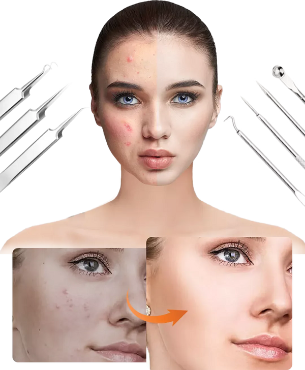 Mitesserentferner Set PureSkinX | Präzise & Hygienisch | Edelstahl Tools für klare Haut