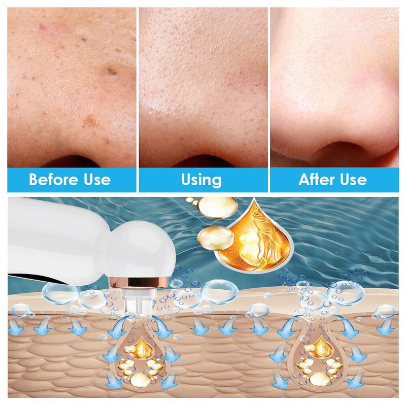 SkinNova Hydrodermabrasion Gesichtsreiniger | Porentiefe Reinigung & Feuchtigkeit | Mit Vakuum- & Wassertechnologie