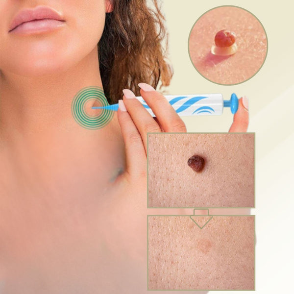 DermaLinx Warzenentferner | Schmerzfreie Entfernung von Warzen & Muttermalen | Für Zuhause | Ohne OP