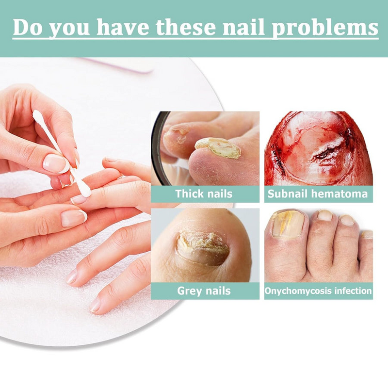 1+1 GRATIS | NailBloom – Sag brüchigen Nägeln für immer Lebewohl