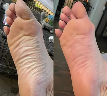 SoftFeet – Seidig glatte Füße in Sekunden!