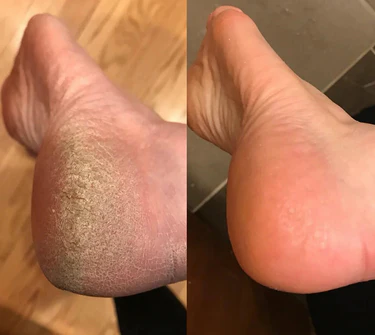 SoftFeet – Seidig glatte Füße in Sekunden!