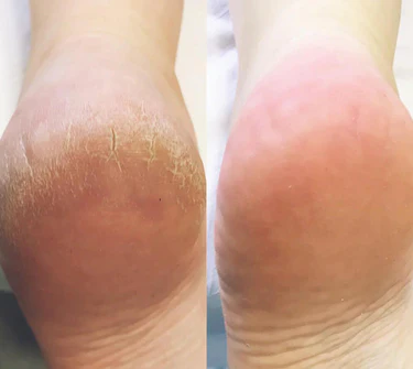 SoftFeet – Seidig glatte Füße in Sekunden!