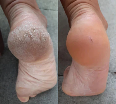 SoftFeet – Seidig glatte Füße in Sekunden!